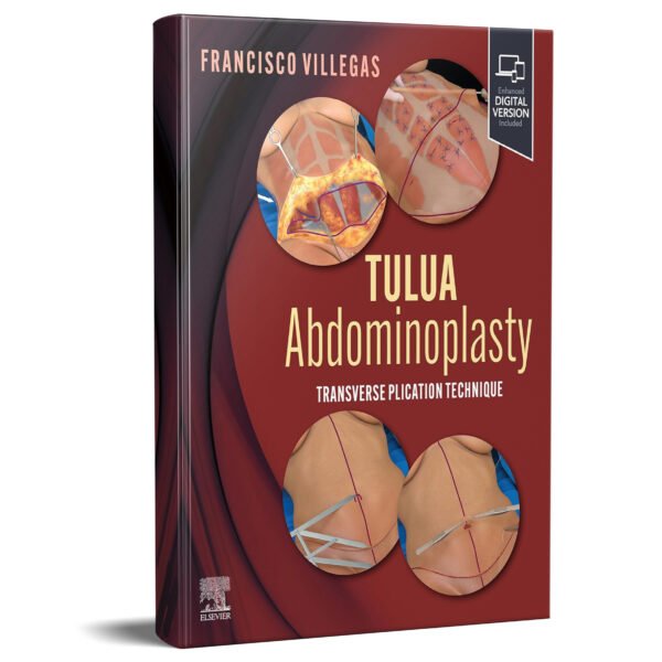 TULUA Abdominoplasty: Transverse Plication Technique 1st Edition